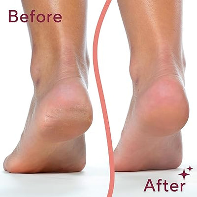 Electric Feet Callus Removers